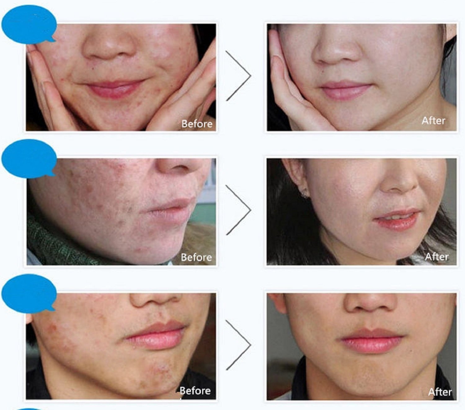 Bioaqua Pure Skin Acne Rejuvenation Cream thumbnail 7
