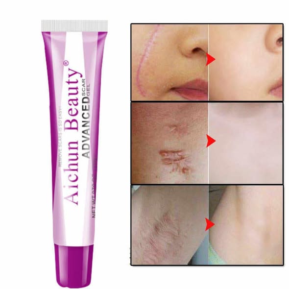 Aichun Beauty Acne Scar Gel Cream thumbnail 4