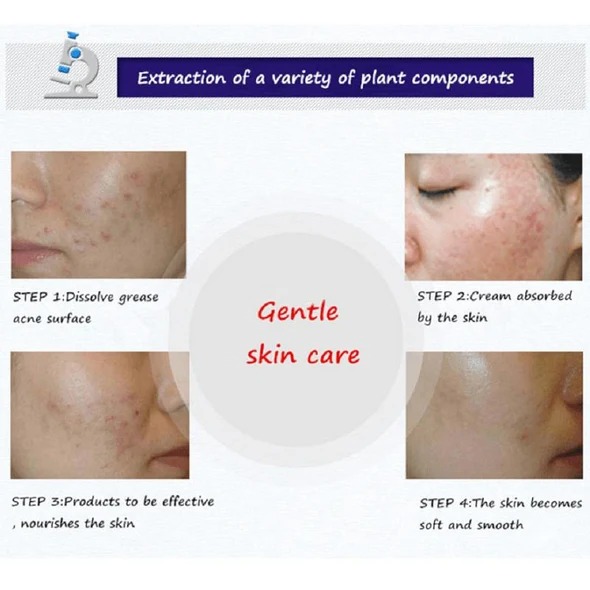 Bioaqua Anti Acne Face Cream for Acne-Prone Skin thumbnail 3